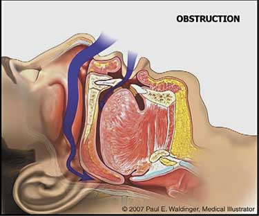 sleep apnea