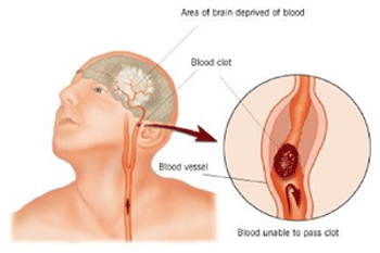 stroke diagrahm